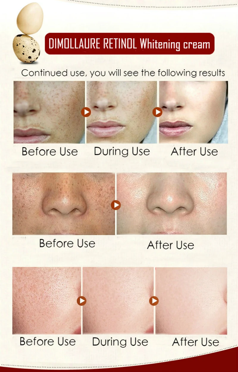 riduri nazolabiale ce să faci cea mai bună cremă anti-îmbătrânire pentru acnee predispusă